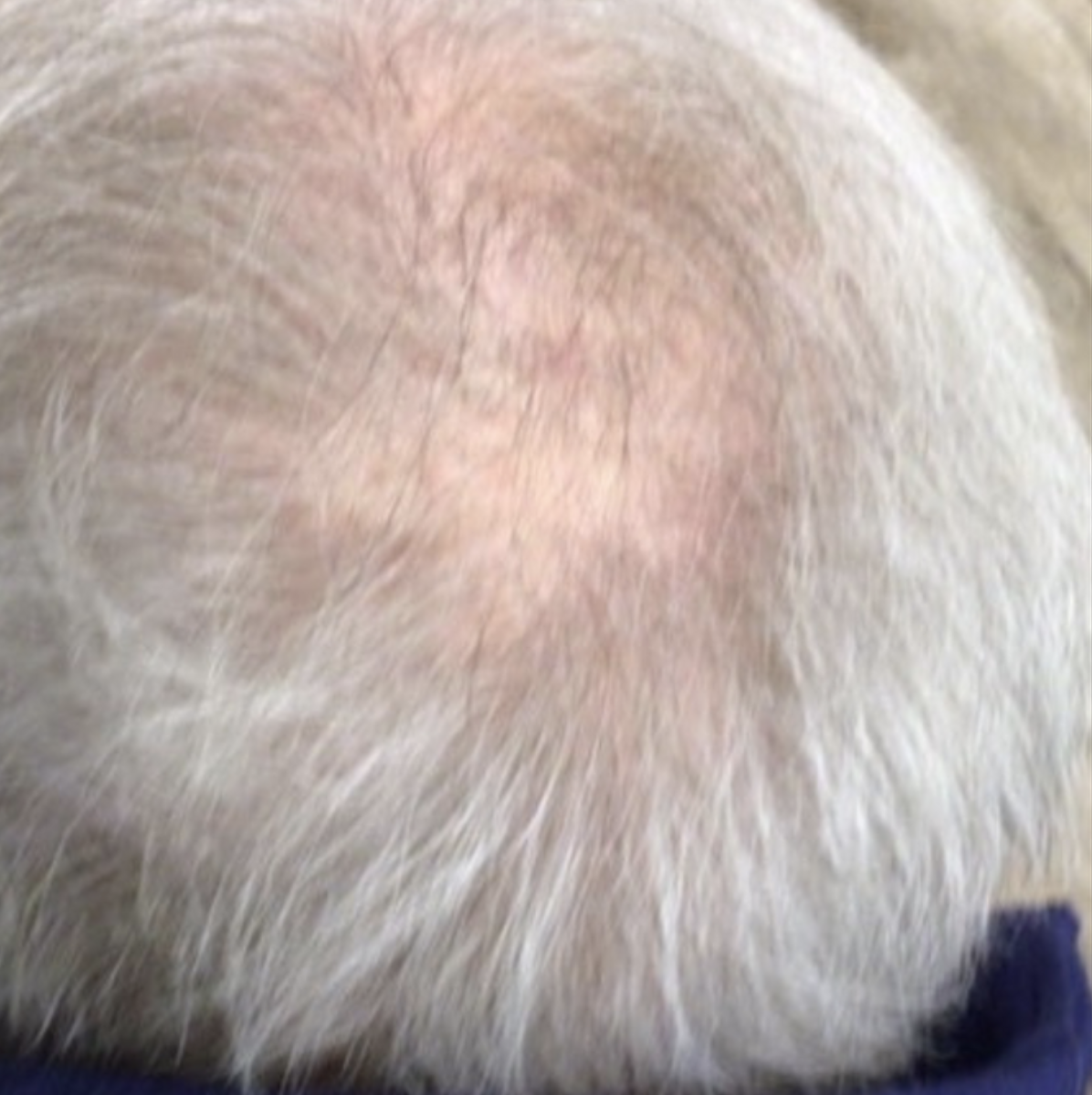 PRP Hair Restoration